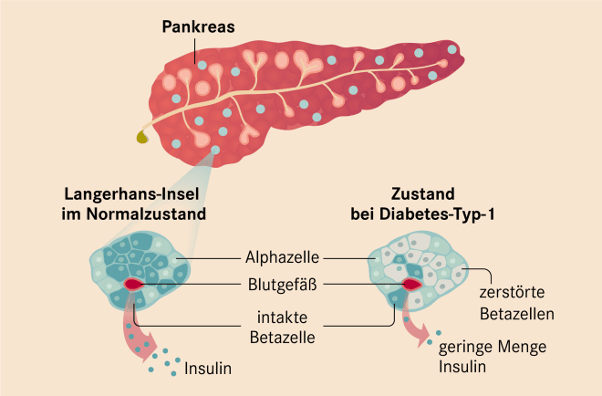 Diabetes Typ 1: Ursachen, Symptome, moderne Therapien | Apotheken Umschau