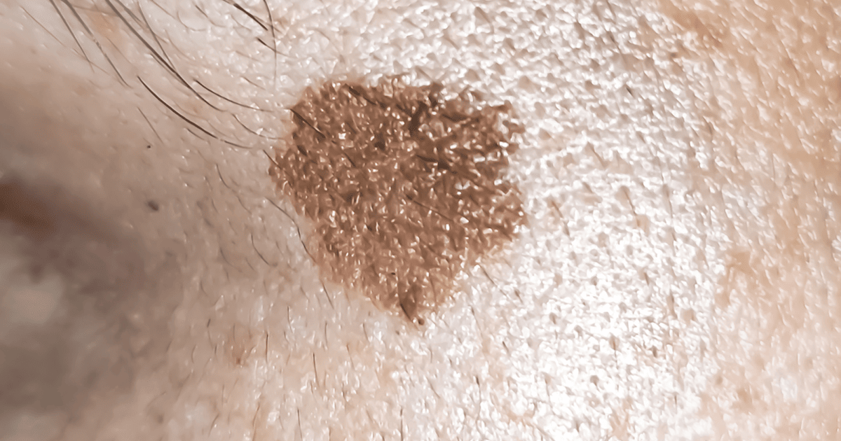 Aktinische-Keratose-Nehmen-Sie-raue-Hautstellen-ernst-