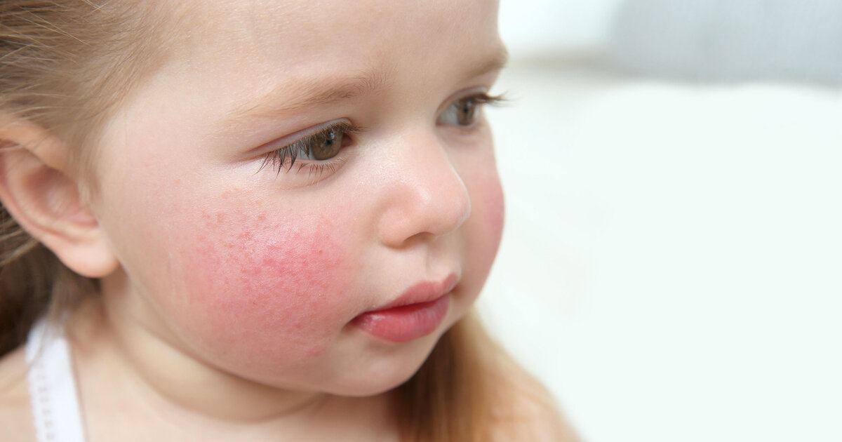 Wie-kann-man-sich-mit-Ringelr-teln-anstecken-