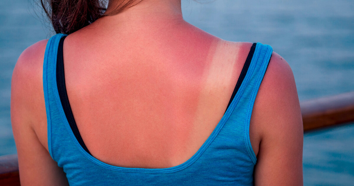 Ich-habe-einen-schlimmen-Sonnenbrand-was-hilft-schnell-