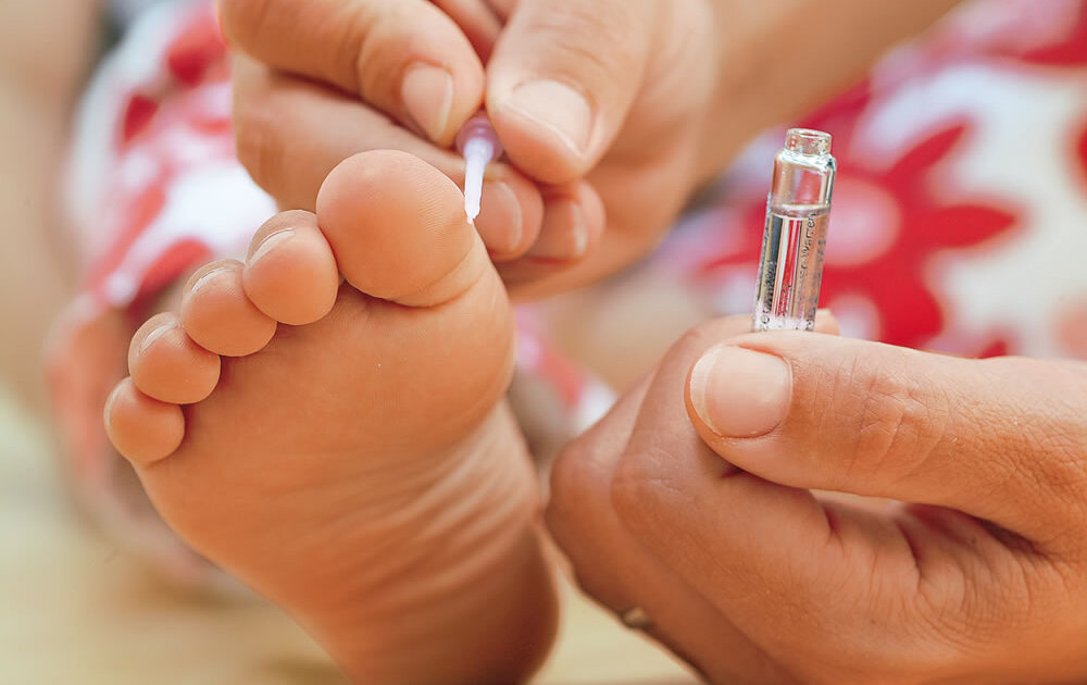 Warzen-bei-Kindern-Was-hilft-