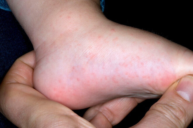 Was Hilft Gegen Hand Mund Fuss