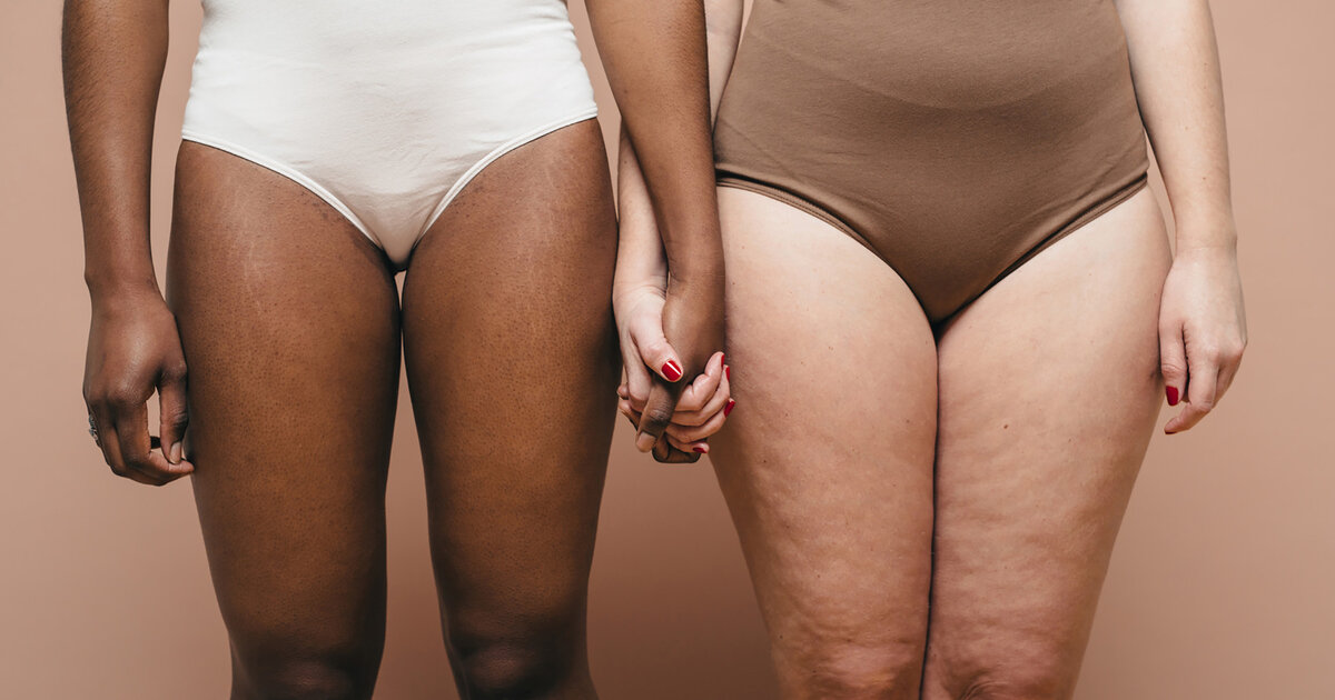 Cellulite-Orangenhaut-kurz-und-knapp-erkl-rt