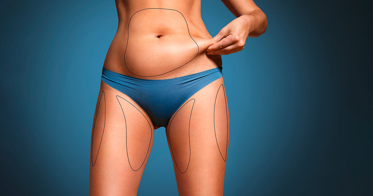 Das-passiert-bei-einer-Fettabsaugung-Liposuktion-