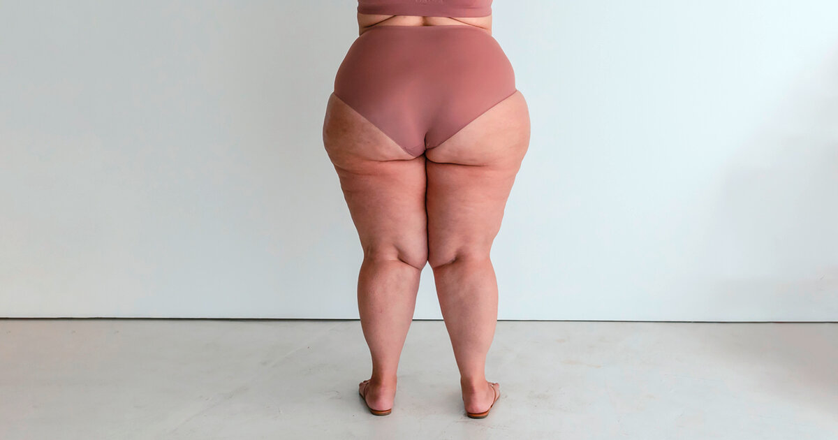 Lip-dem-Fettabsaugung-Liposuktion-wird-Kassenleistung