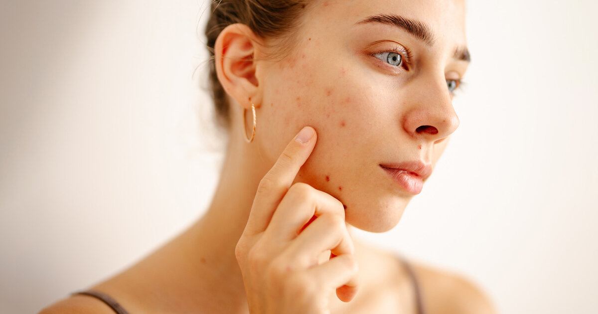 Isotretinoin-bei-schwerer-Akne-Wirkung-und-Nebenwirkungen
