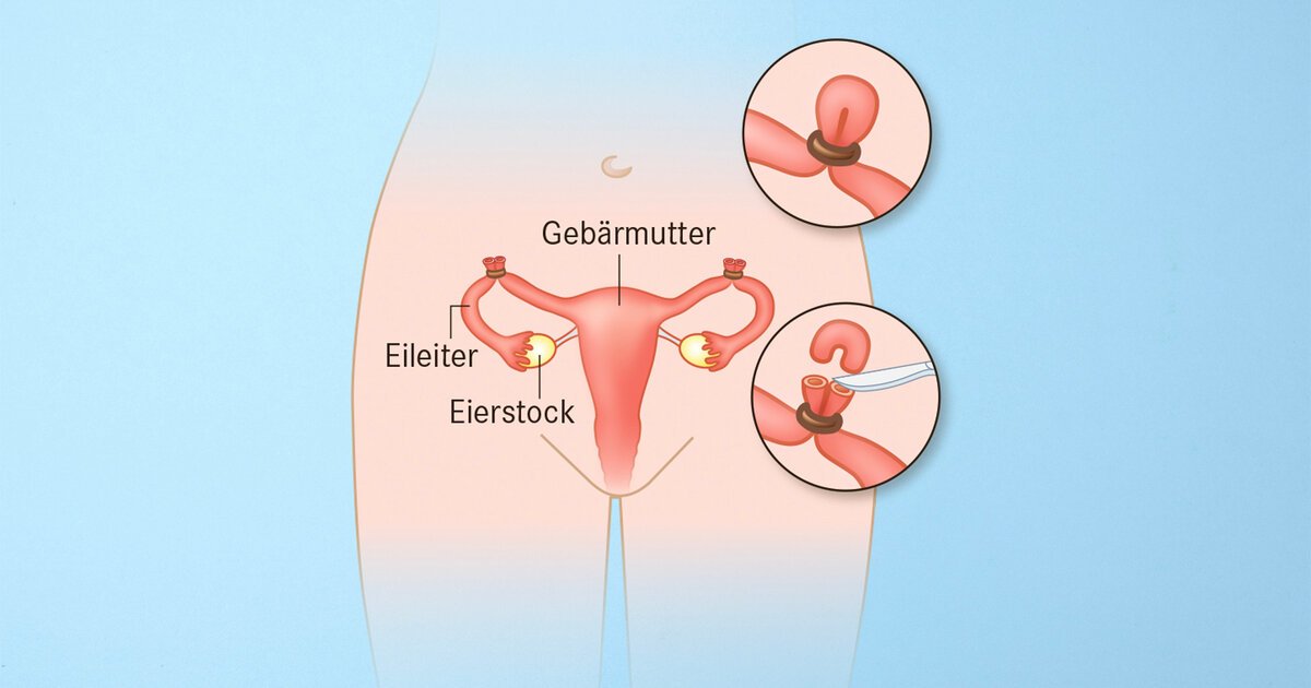Sterilisation bei Frauen: Vor- und Nachteile der Verhtungsmethode |  Apotheken Umschau