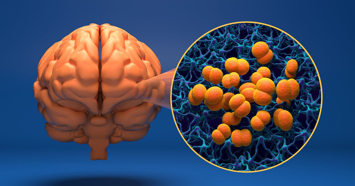 Bakterielle-Meningitis-Symptome-erkennen-schnell-handeln