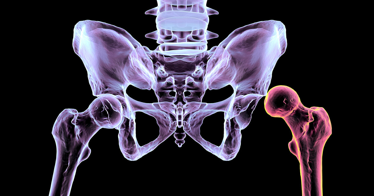 Warum-H-ftdysplasie-bei-Babys-fr-h-behandelt-werden-sollte