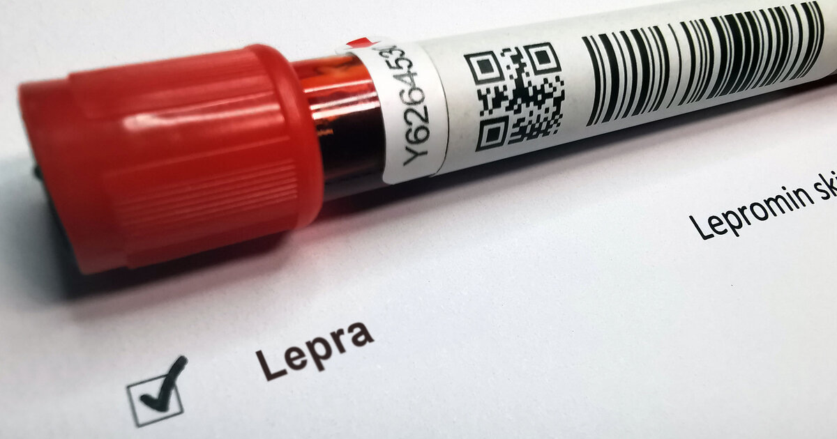 Lepra-in-Europa-Was-Sie-ber-die-Krankheit-wissen-sollten