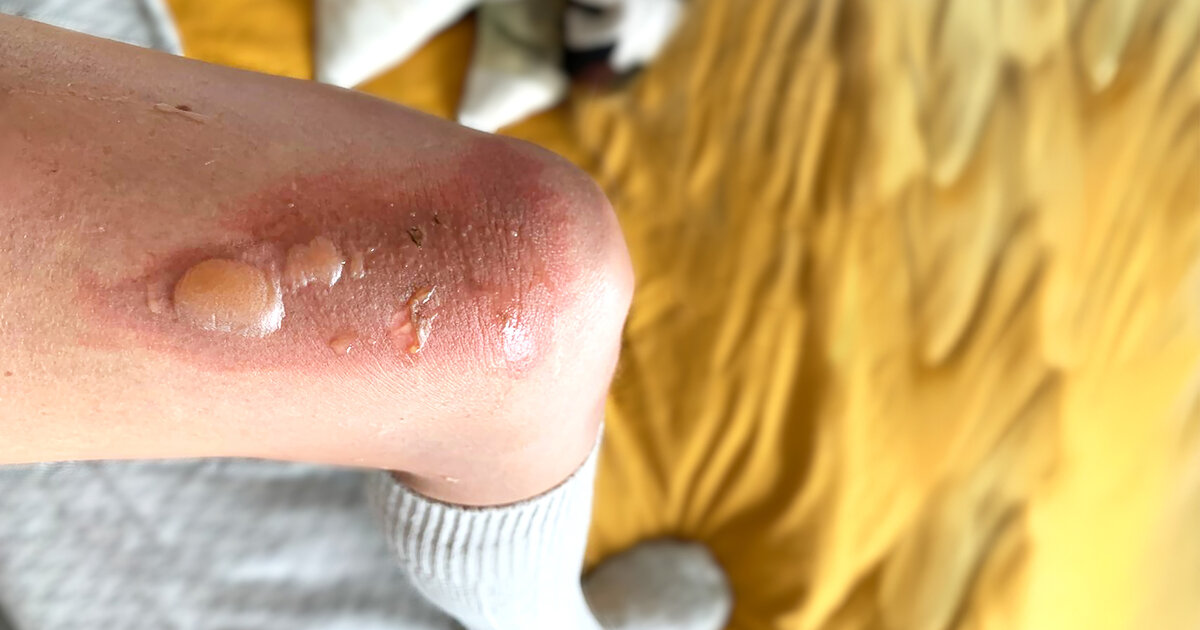 Die-vier-Verbrennungsgrade-erkl-rt-Wann-sofort-zum-Arzt-