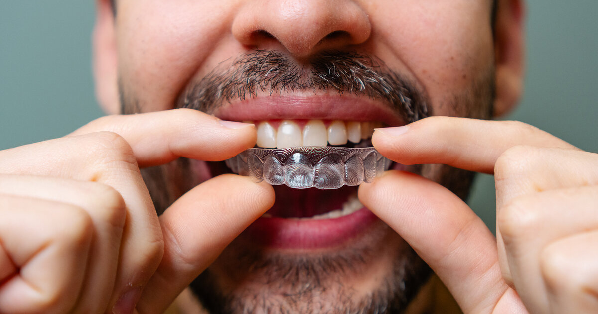 Aligner-f-r-gerade-Z-hne-Chancen-und-Grenzen-der-Behandlung
