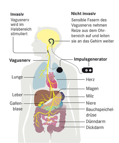Rheuma Patienten Aufgepasst! So Wirkt Der Antientzündlicher Reflex: Vagusnerv Stimulation (Und Was Ärzte Nicht Verraten). - e07gs8a