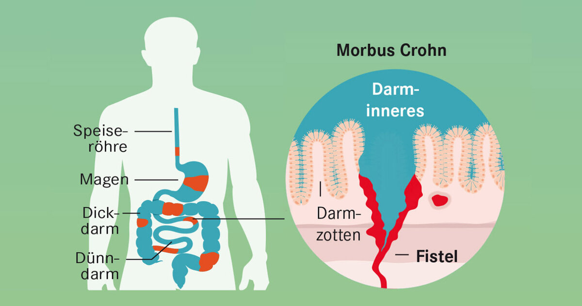Endlich Ruhe im Darm Neue Therapie bei Morbus Crohn und Colitis Apotheken Umschau