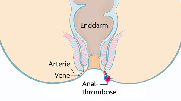 Wie Sieht Eine Analthrombose Aus www.apotheken-umschau.de