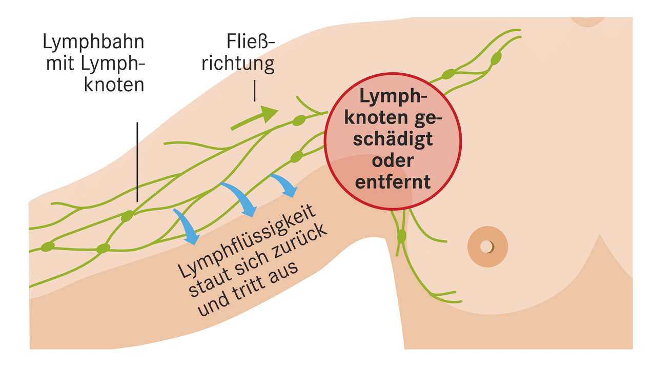 Lymphknoten achsel bilder