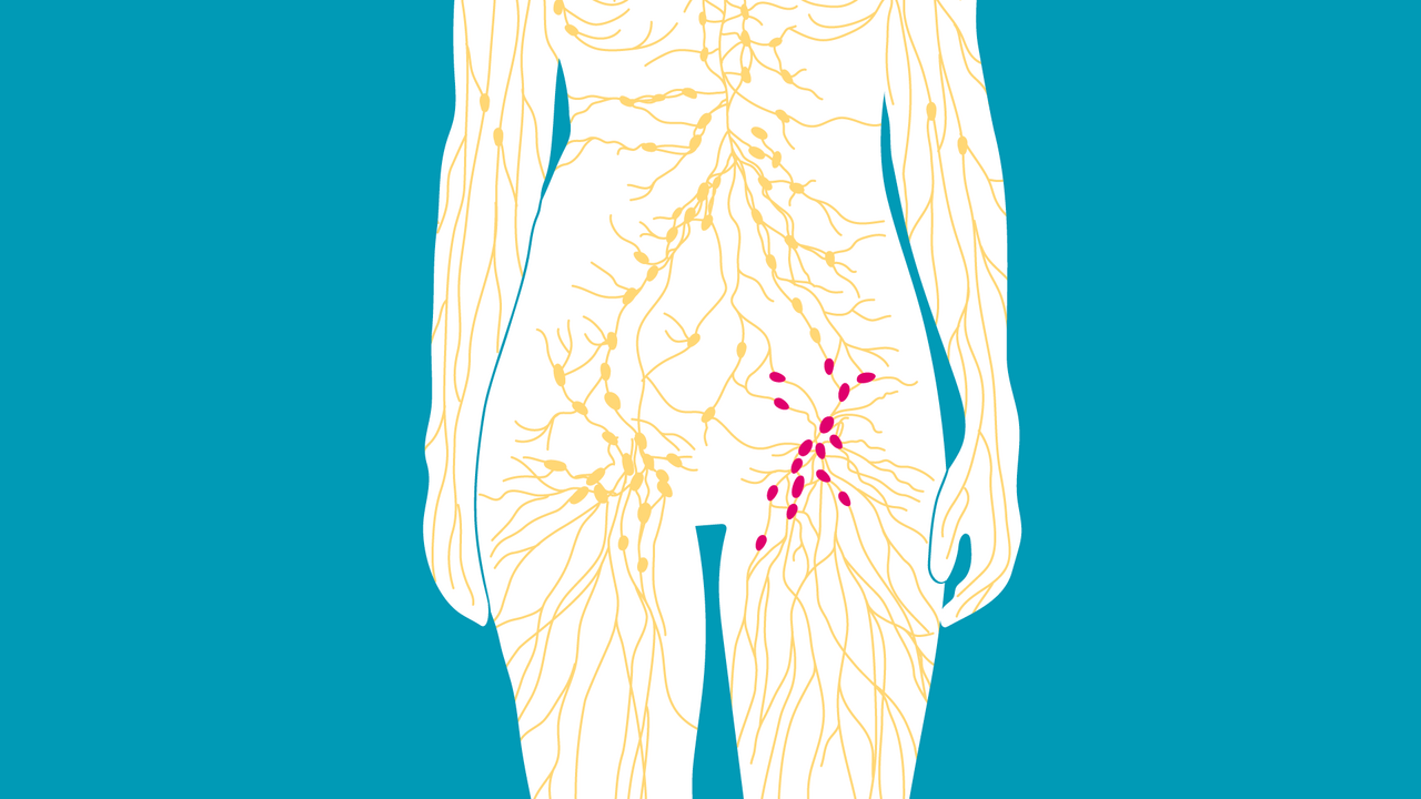 Was bedeuten Lymphknotenschwellungen in der Leiste?