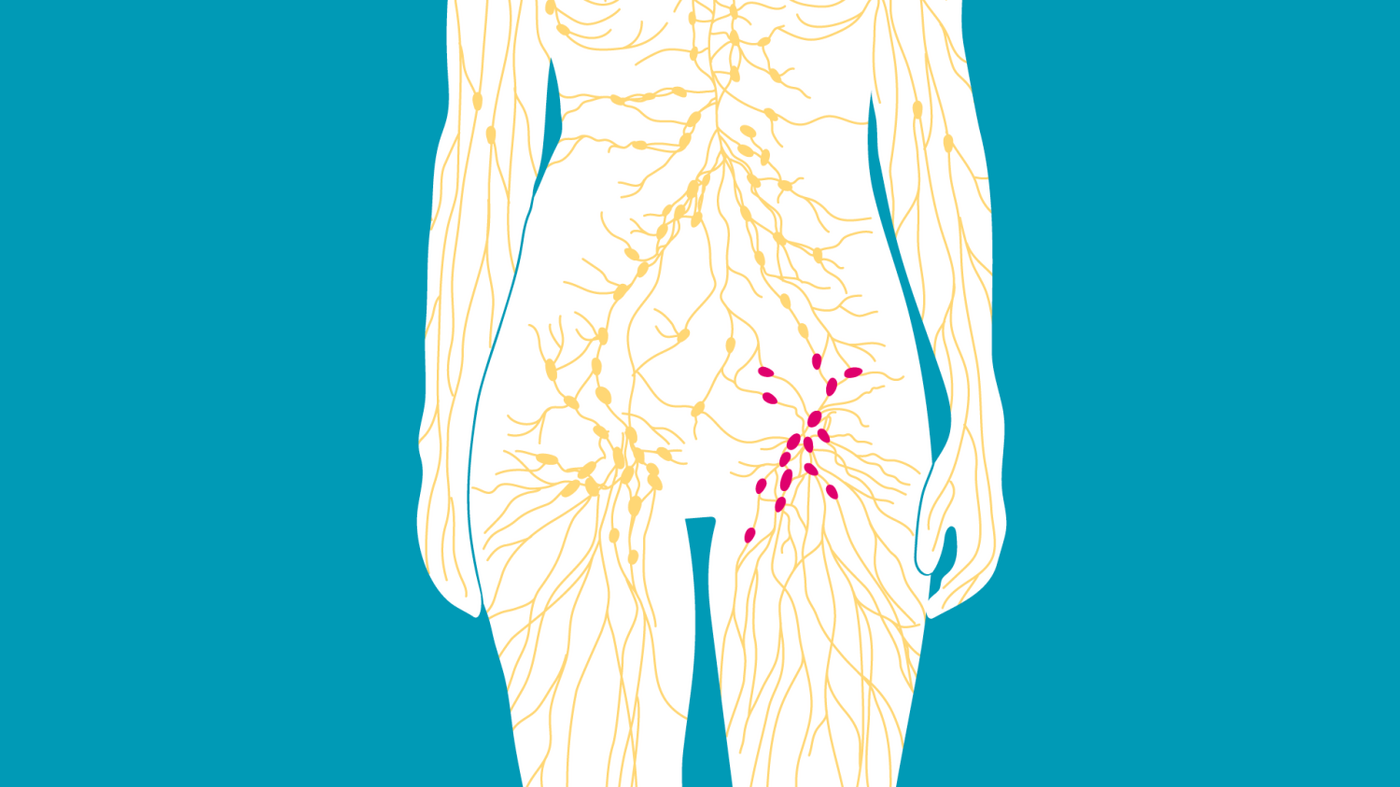Was bedeuten Lymphknotenschwellungen in der Leiste? | Apotheken Umschau