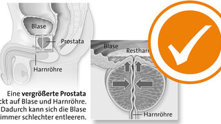 Prostata Restharnbildung bei Prostatavergrößerung