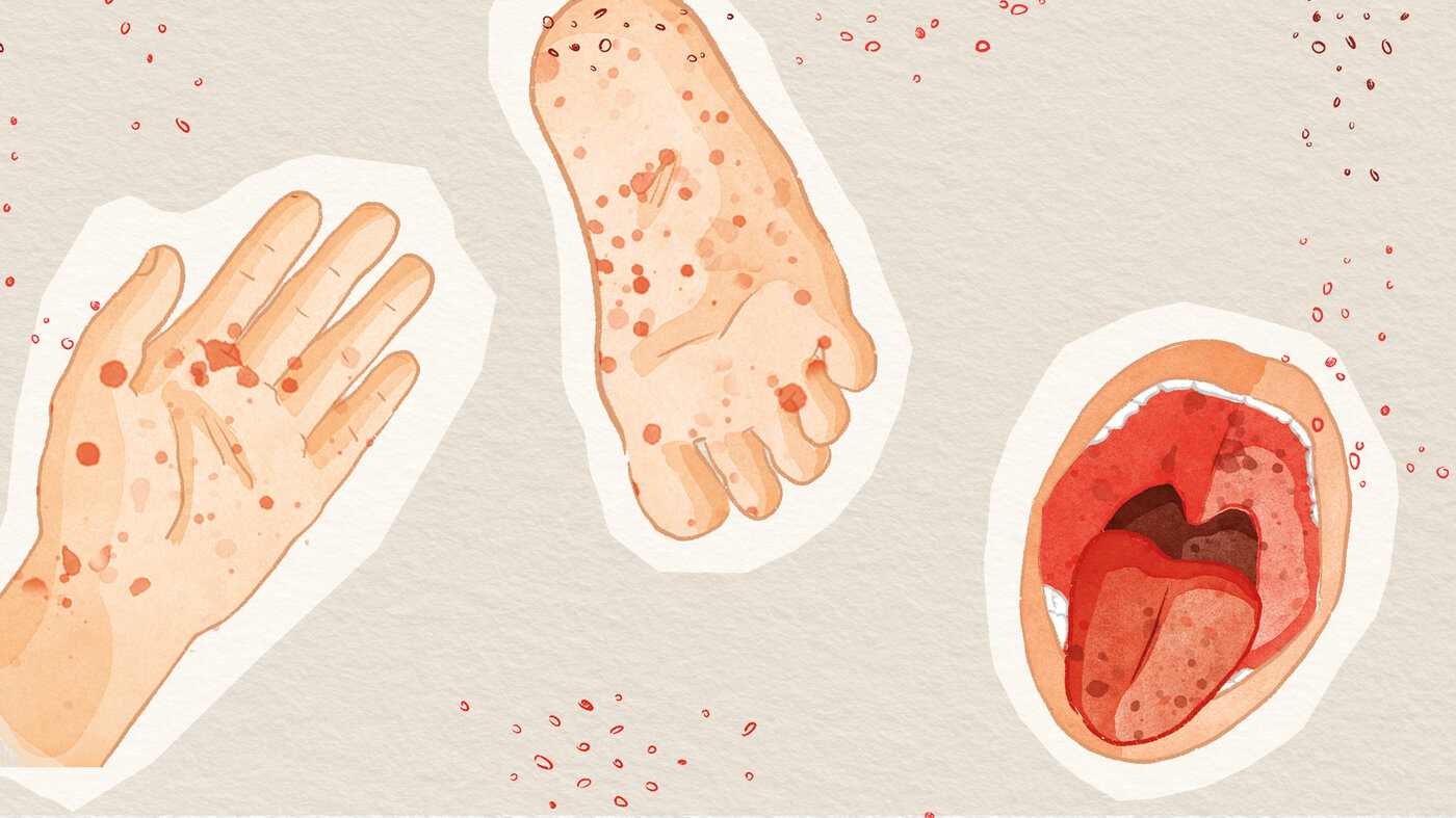 Hand-Fuß-Mund-Krankheit: Ist sie für Erwachsene ansteckend? | Apotheken  Umschau
