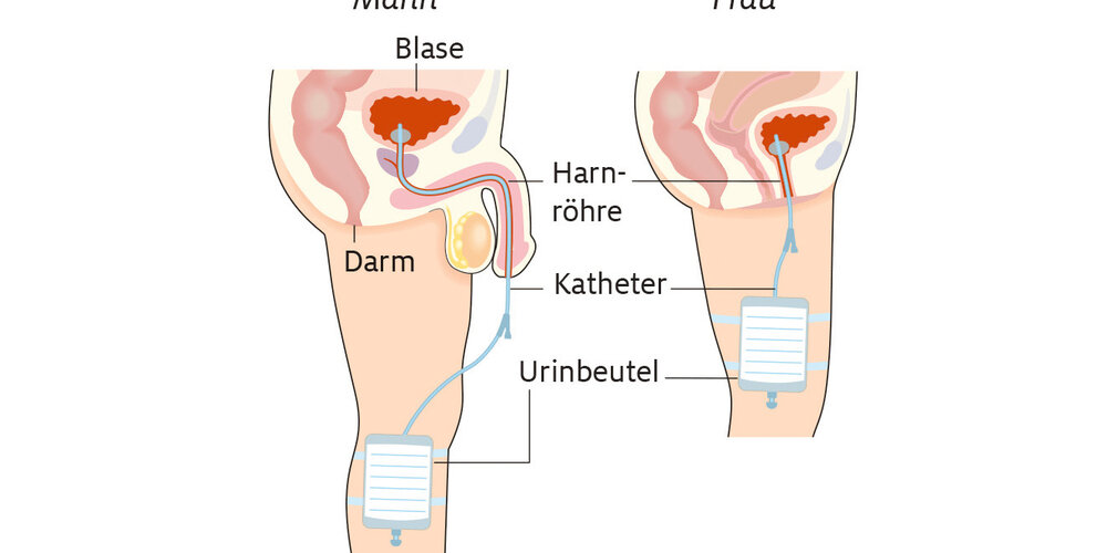 Wie Lange Beschwerden Nach Blasenkatheter