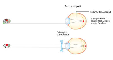 Kurzsichtigkeit: Ursachen und Therapie | Apotheken Umschau