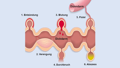 Mastdarmkrebs Rektumkarzinom Definition Anzeichen Therapie mastdarmkrebs-rektumkarzinom-definition-anzeichen-therapie