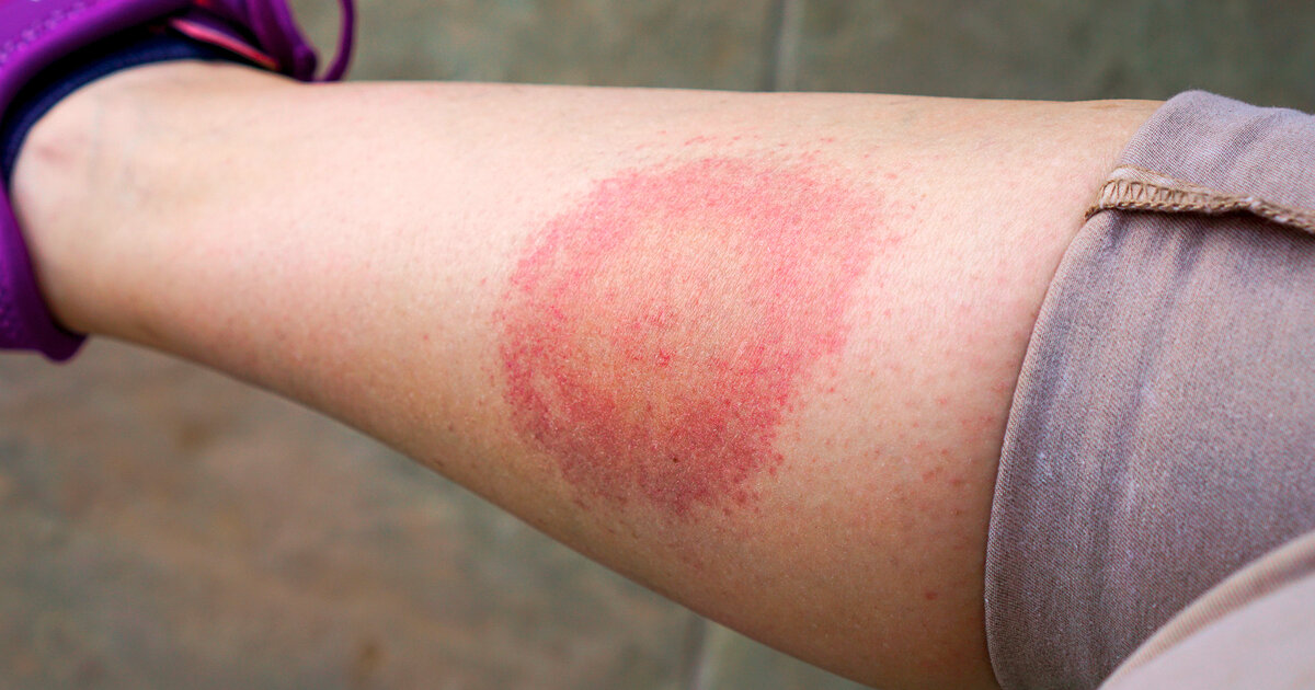 Lyme-Borreliose-Was-nach-einem-Zeckenstich-wichtig-ist