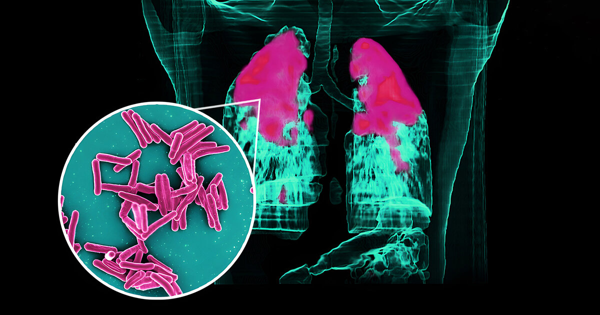 Tuberkulose-Ursachen-Symptome-und-Behandlung-der-TBC