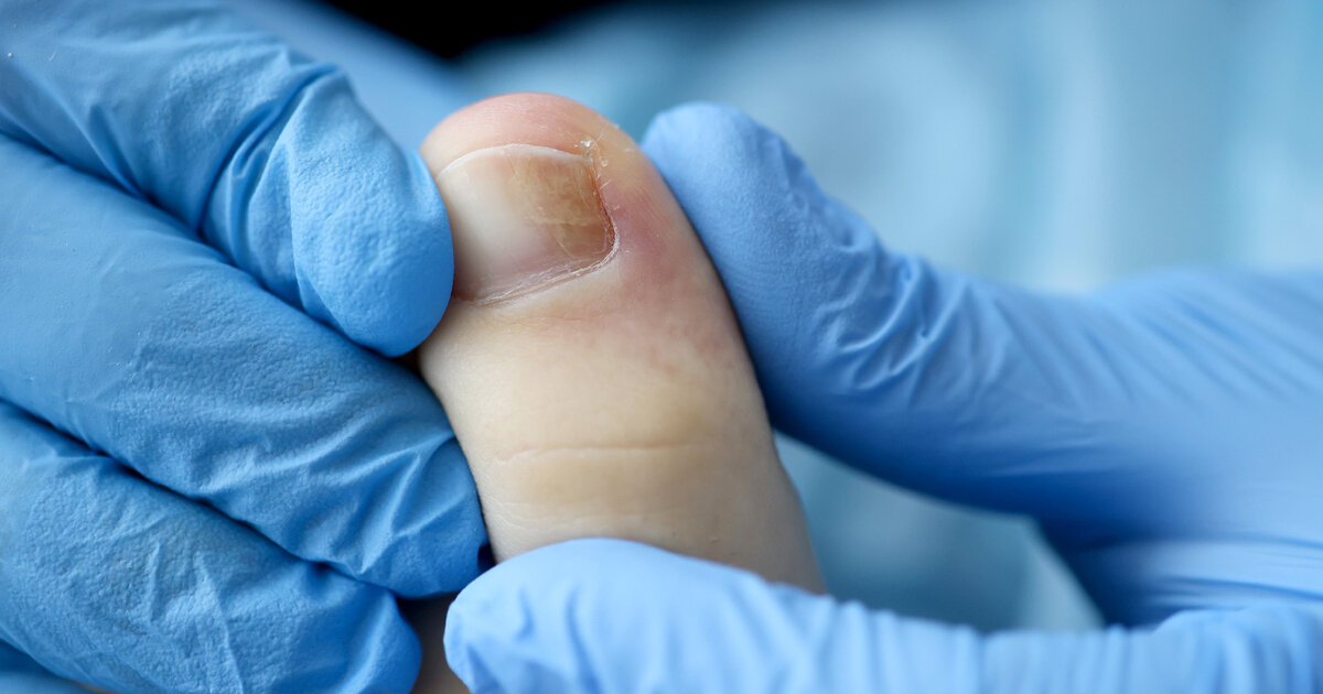 Nagelpilz-Wie-loswerden-