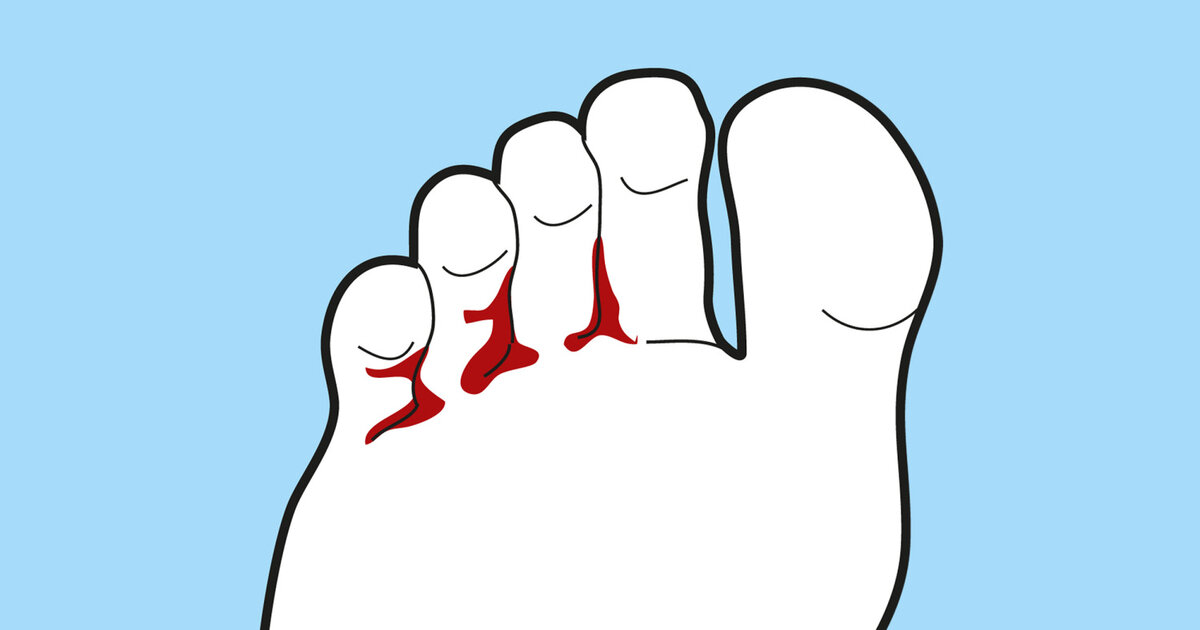 Fußpilz: Symptome und Behandlung | Apotheken Umschau