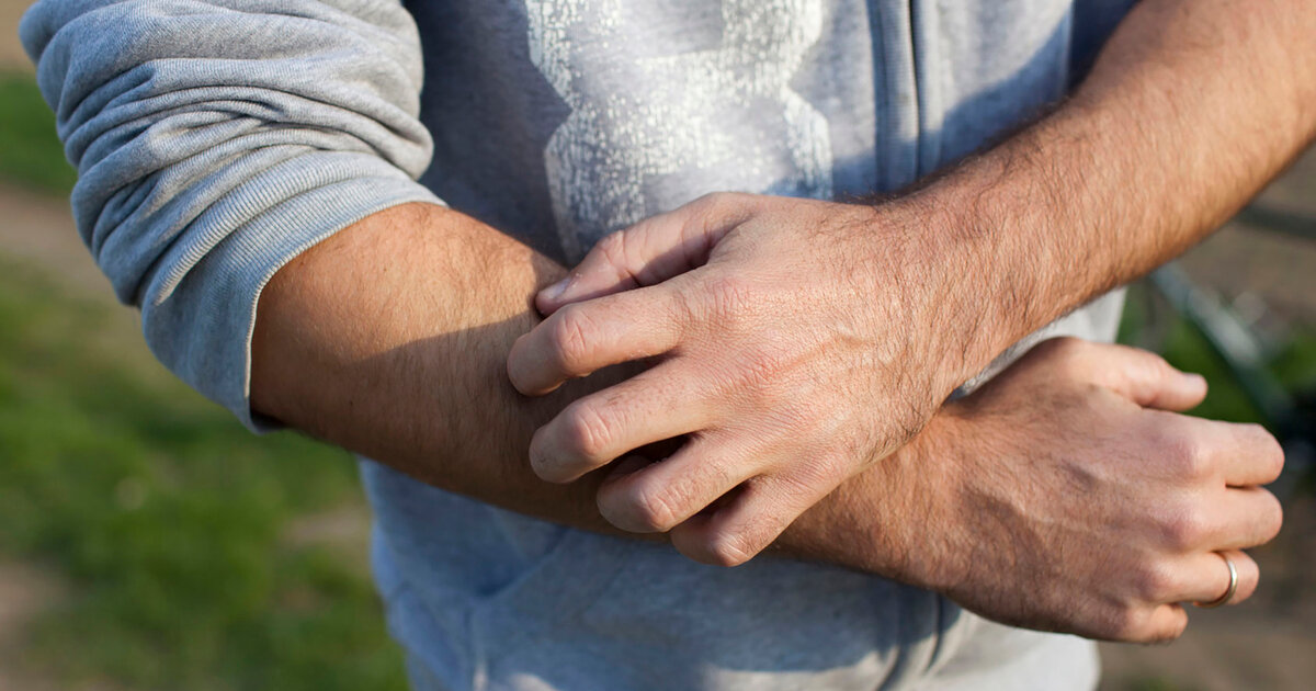 Wenn-es-h-llisch-juckt-Was-tun-wenn-man-Kr-tze-hat-