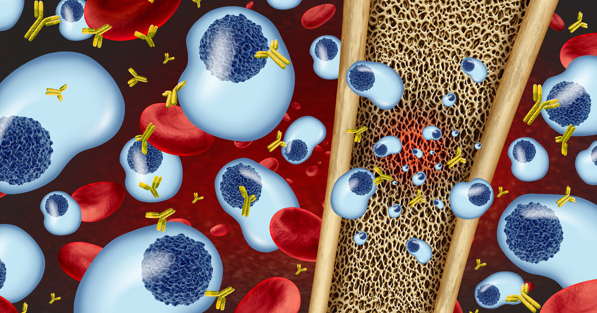 Multiples-Myelom-Symptome-Therapie-Heilungschancen