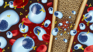 Illustration von Knochenmarkkrebs (multiples Myelom)