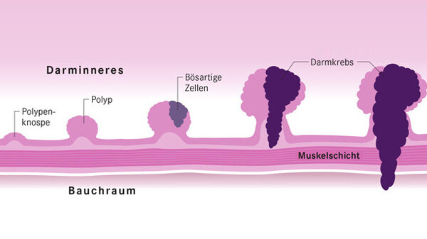 Darmpolypen Ab Welcher Größe Gefährlich www.apotheken-umschau.de
