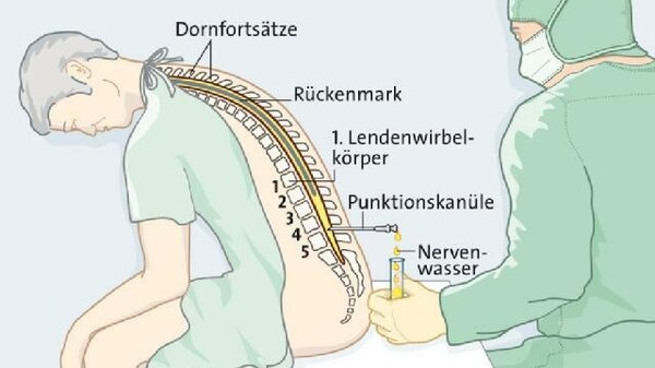 2 Wochen Nach Lumbalpunktion Rückenschmerzen www.apotheken-umschau.de