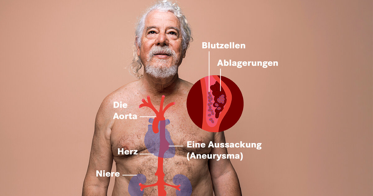 Aortenaneurysma-Symptome-Risiko-und-wie-behandelt-wird