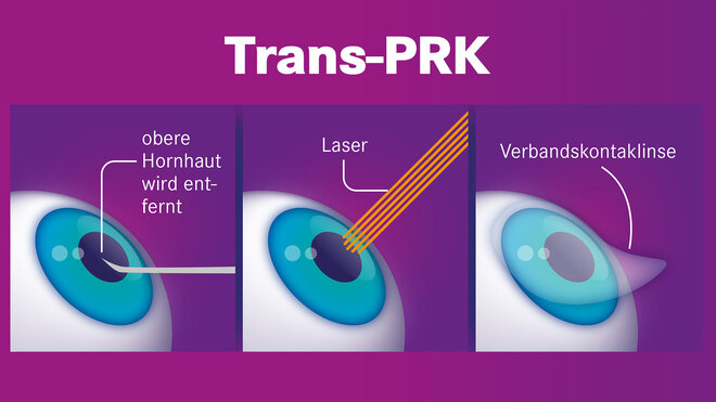 Augen lasern ohne lasern clearance